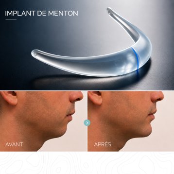Image implant de menton puis en dessous photos avant après de profil d'un homme avec et sans implant
