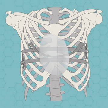 Nuss Ravitch or Implants for Pectus surgery?