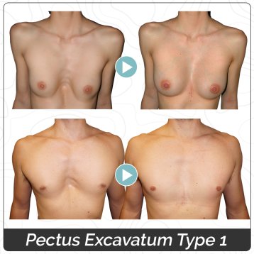 Photos avant/après de Pectus Excavatum symétriques chez la femme et l'homme