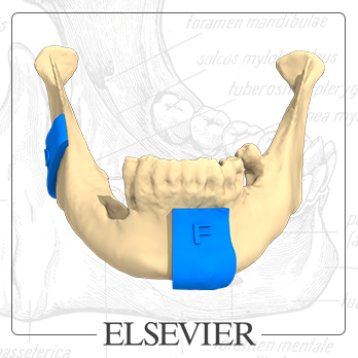 Contribution of 3D printing to mandibular reconstruction after cancer