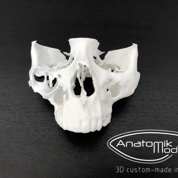  Impresión 3D: un nuevo enfoque para anticipar la cirugía