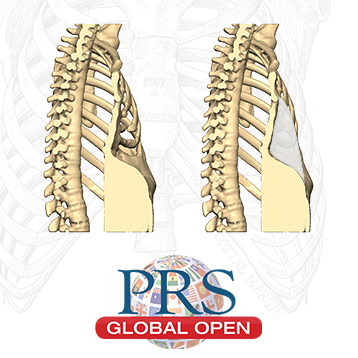 PRS Global Open – Least-Invasive Pectus Excavatum Reconstruction With Patient-Specific 3D Chest Wall Implants