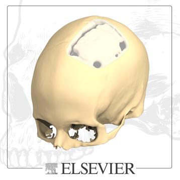 Cranial vault depression with 3D scutom-made implant