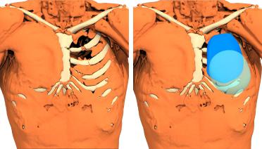 Woman - Poland Type 2 - 1 year later - 3D view