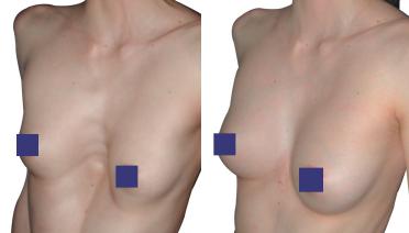 Woman - Pectus Type 1 - 3 months later - side view