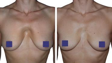 Woman - Pectus Type 4 - 1 year later - front view